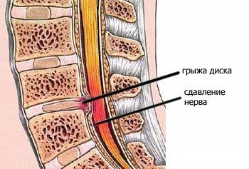 Межпозвонковая грыжа грудного отдела позвоночника симптомы и лечение Москва