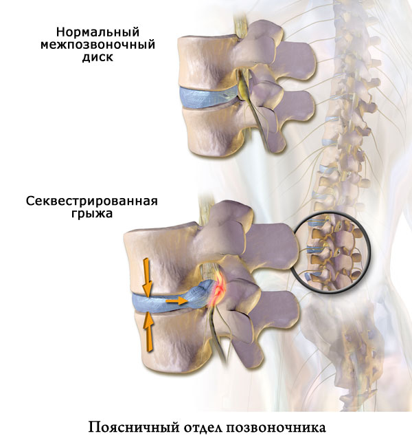 Межпозвонковая грыжа поясничного отдела симптомы и лечение Москва.