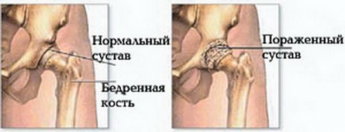 Артроз суставов: симптомы, причины, лечение Москва.
