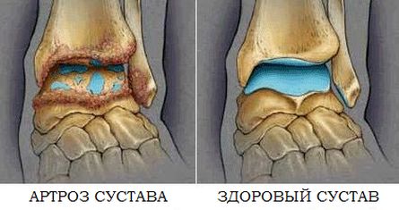 Артроз суставов: симптомы, причины, лечение Москва.