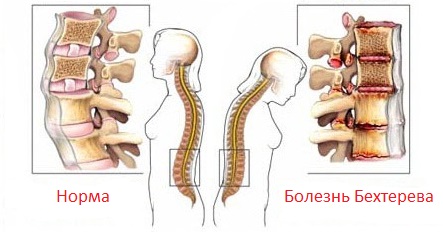 Болезнь Бехтерева симптомы и лечение, массаж Москва