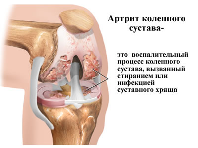 Артрит коленного сустава Москва