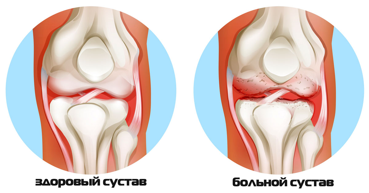 острый артрит коленного сустава Москва