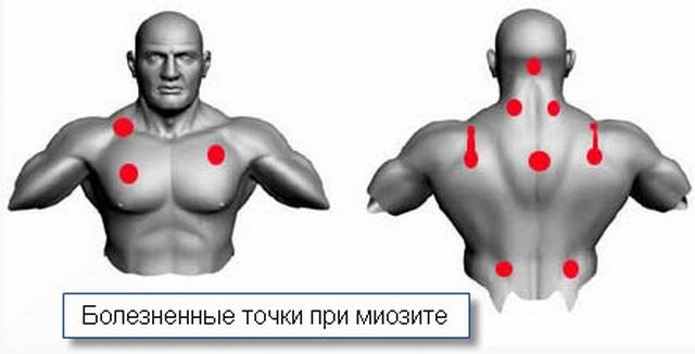 Миозит мышц симптомы и лечение Москва