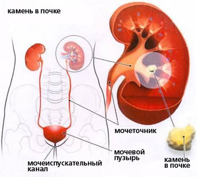 Мочекаменная болезнь у мужчин и женщин: симптомы, признаки, причины, профилактика и лечение заболевания Москва.
