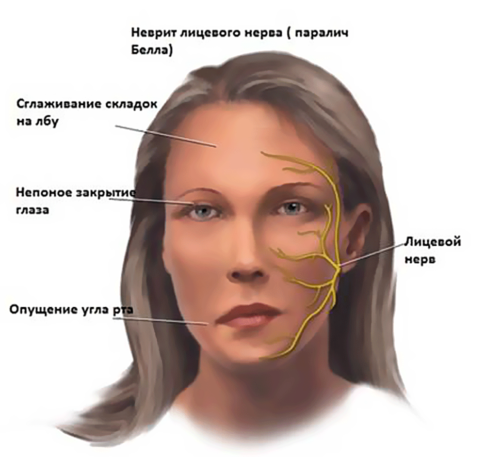 Неврит лицевого нерва: признаки, симптомы и лечение заболевания Москва