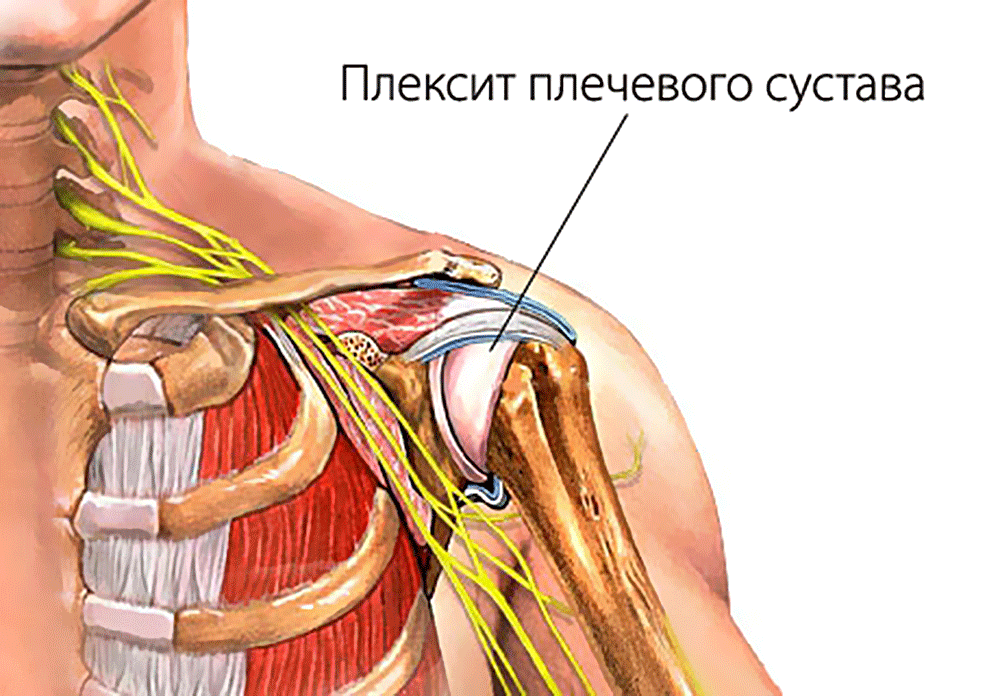 Плексит плечевого сустава симптомы и лечение Москва