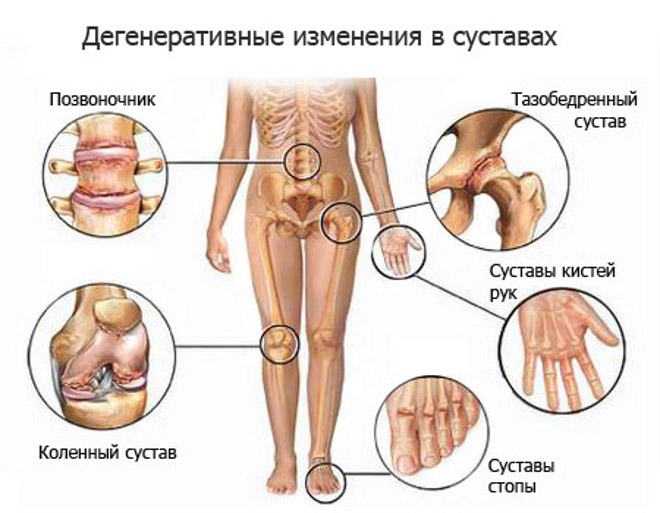 Лечение заболевания полиартрита суставов, симптомы Москва.