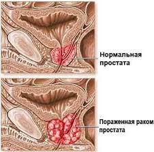 Лечение простатита у мужчин: симптомы, признаки, причины Москва.