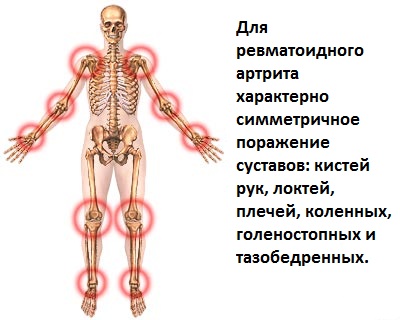 Лечение ревматоидного артрита коленного, тазобедренного, голеностопного, плечевых суставов Москва