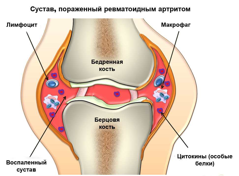 Лечение ревматоидного артрита коленного, тазобедренного, голеностопного, плечевых суставов Москва